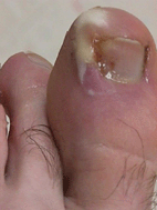 Infected ingrown toe nail