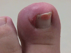 ingrown toe nail treatment